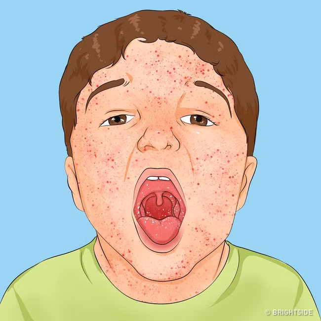 Có những căn bệnh nguy hiểm ở trẻ ẩn sau những triệu chứng tưởng là cảm sốt thông thường - Ảnh 9.