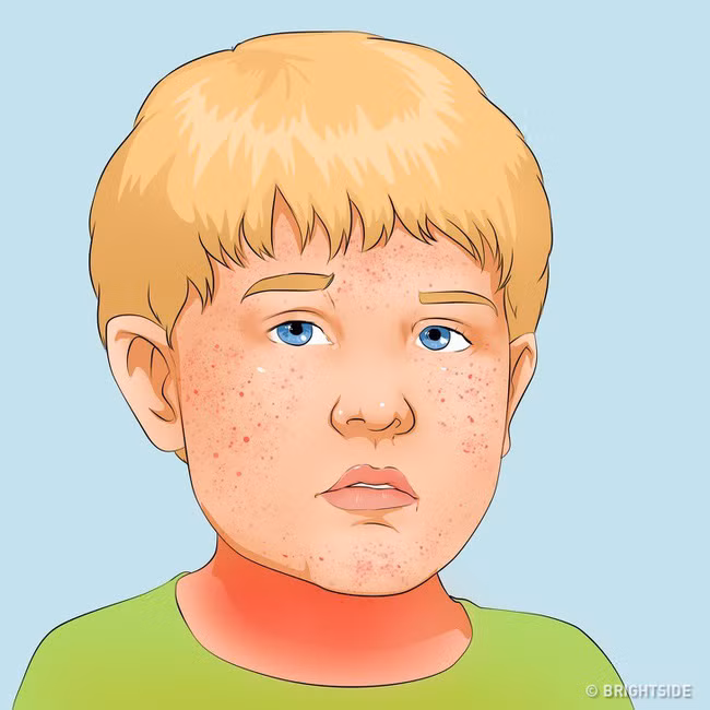 Có những căn bệnh nguy hiểm ở trẻ ẩn sau những triệu chứng tưởng là cảm sốt thông thường - Ảnh 4.