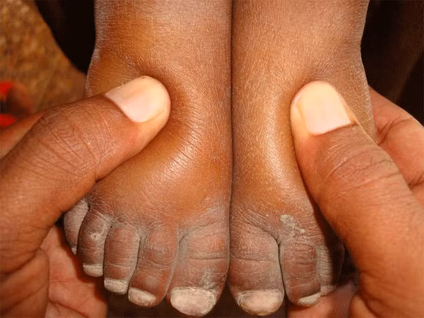 Bị muỗi đốt, bàn chân cô gái 21 tuổi sưng to gấp 3 lần