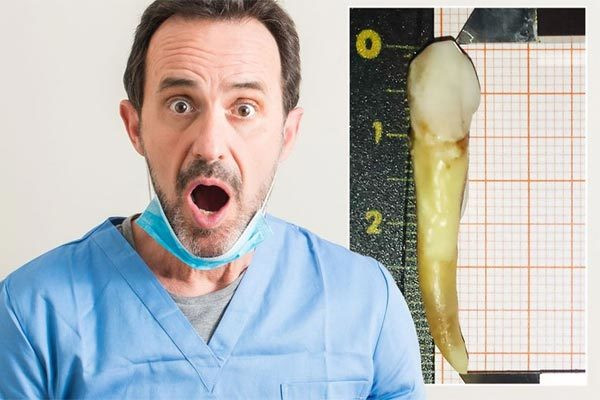 Lập kỷ lục Guinness nhờ chiếc răng dị thường, dài nhất thế giới ảnh 2 Lập kỷ lục thế giới nhờ chiếc răng dị thường