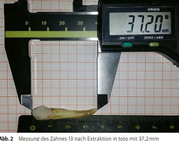 Lập kỷ lục Guinness nhờ chiếc răng dị thường, dài nhất thế giới ảnh 1 Lập kỷ lục thế giới nhờ chiếc răng dị thường