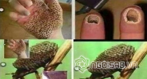 côn trùng gây bỏng da chết người 0 côn trùng gây bỏng da chết người 0