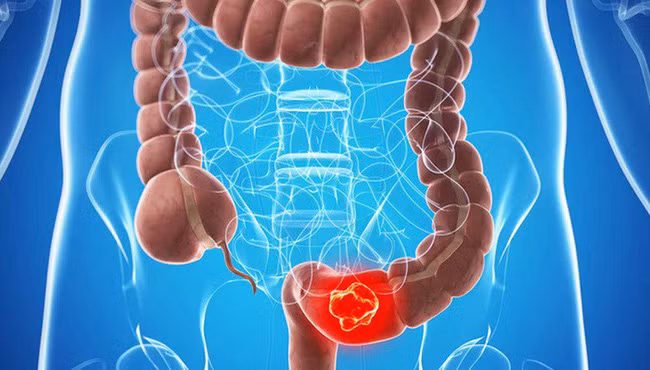 Các triệu chứng ung thư đại trực tràng rất dễ bị bỏ qua - Ảnh 4.