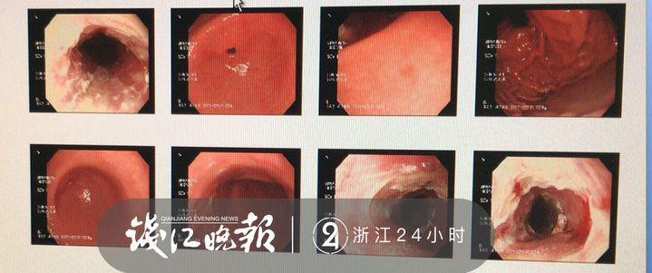Bị ăn mòn dạ dày vì quên một việc cực quan trọng khi uống thuốc ảnh 1 chang trai tre bi an mon da day vi quen mot viec cuc quan trong khi uong thuoc - 1