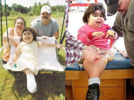 Sức sống thần kì của bé gái có đôi chân dính liền như đuôi cá ảnh 4 Sức sống thần kì của bé gái có đôi chân dính liền như đuôi cá ảnh 4