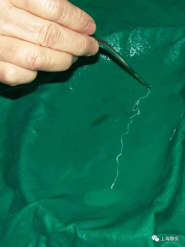 Con trai 28 tuổi bị “ăn” mất não, bác sĩ nói nguyên nhân khiến cha đau đớn vì hối hận ảnh 2 chang trai 28 tuoi bi "an" mat nao, bac si noi nguyen nhan khien nguoi cha lap tuc hoi han - 4