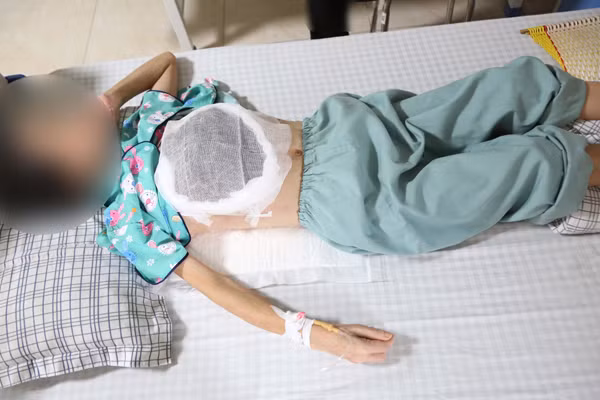 Bệnh nhân suy kiệt do khối u to nhanh, vỡ loét, chảy mủ sau gần 2 năm đắp lá.