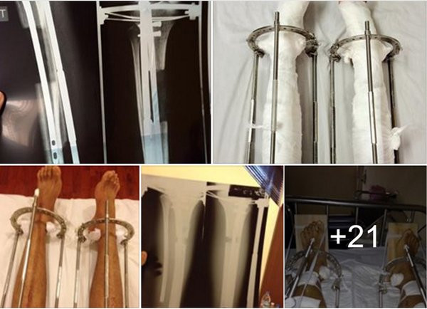 Quá trình kéo dài chân qua trinh keo dai chan