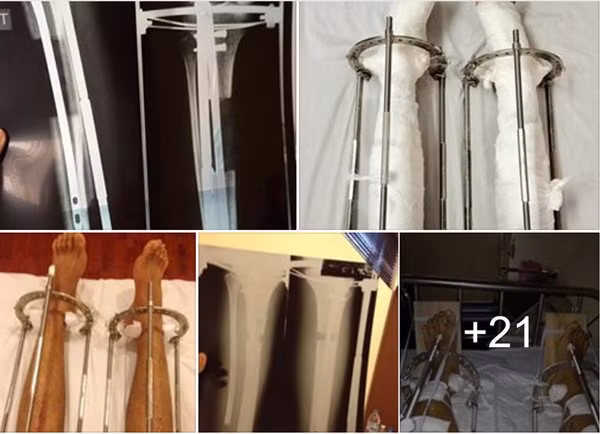 Quá trình kéo dài chân qua trinh keo dai chan