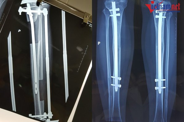 Ảnh chụp x quang ca kéo dài chân anh chup x quang ca keo dai chan