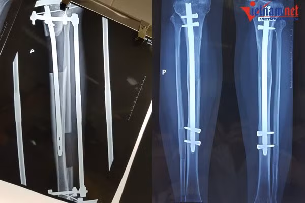 Ảnh chụp x quang ca kéo dài chân anh chup x quang ca keo dai chan