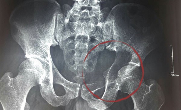 khối u,khớp háng,bệnh viện K khối u,khớp háng,bệnh viện K