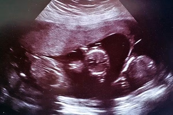 phau thuat bo thai ve van thay nghen, me nhap vien kham bac si cung phai ngo ngang - 1