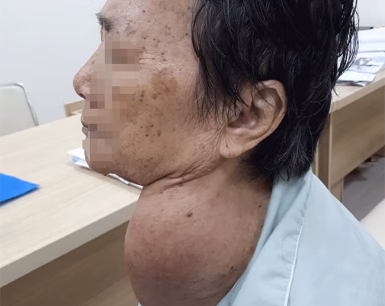 Bệnh nhân Lê Thị T., 73 tuổi có khối bứu khổng lồ đã được phẩu thuật thành công nhờ phương pháp mới ứng dụng đèn soi thanh quản tự chế 