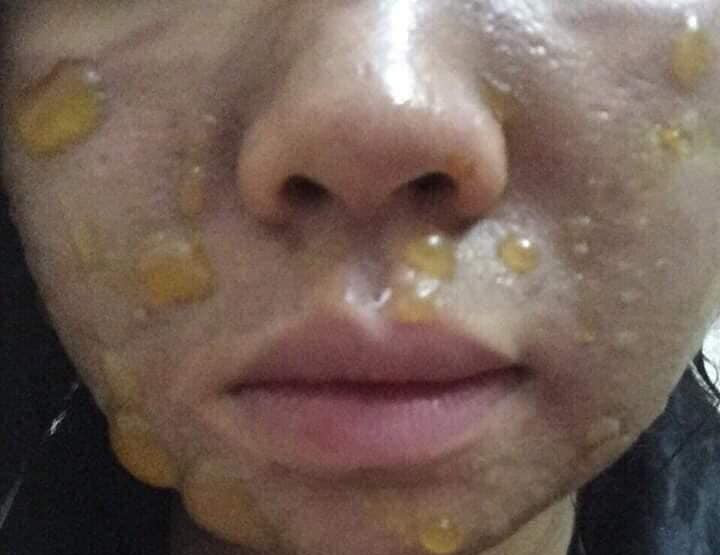 Tự ý peel da tại nhà với những loại dung dịch lột da mua qua mạng, spa... có thể khiến bạn nhận trái đắng.