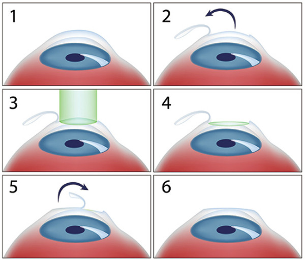 Các bước trong phương pháp phẫu thuật Lasik. Ảnh: DMD