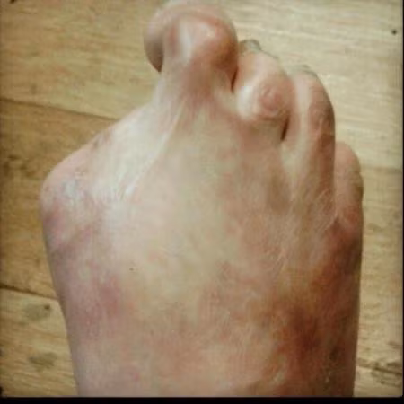 Ban đầu, cô gái chỉ phải cắt bỏ một ngón chân cái...