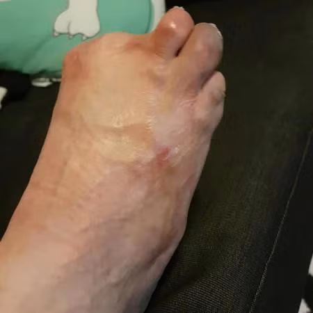 ...nhưng sau đó là lần lượt những ngón chân tiếp theo