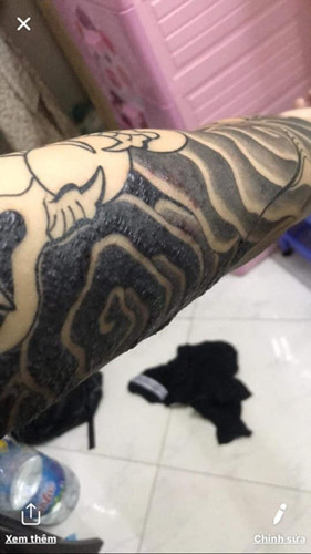 "Rợn tóc gáy" hình ảnh khách hàng bị nhiễm trùng, mưng mủ do xăm mực "dởm" - Hình 10 Rùng mình hình ảnh khách bị nhiễm trùng, mưng mủ do xăm mực “dởm“ ảnh 10