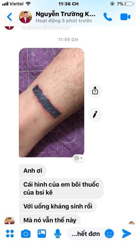 "Rợn tóc gáy" hình ảnh khách hàng bị nhiễm trùng, mưng mủ do xăm mực "dởm" - Hình 8 Rùng mình hình ảnh khách bị nhiễm trùng, mưng mủ do xăm mực “dởm“ ảnh 8