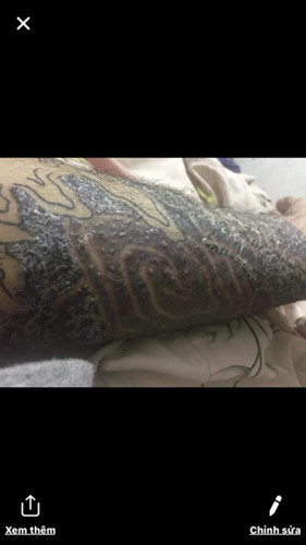 "Rợn tóc gáy" hình ảnh khách hàng bị nhiễm trùng, mưng mủ do xăm mực "dởm" - Hình 9 Rùng mình hình ảnh khách bị nhiễm trùng, mưng mủ do xăm mực “dởm“ ảnh 9