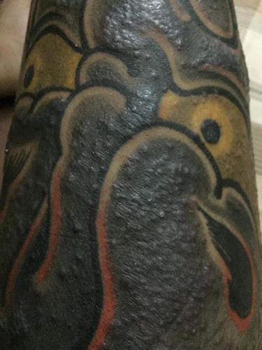 "Rợn tóc gáy" hình ảnh khách hàng bị nhiễm trùng, mưng mủ do xăm mực "dởm" - Hình 6 Rùng mình hình ảnh khách bị nhiễm trùng, mưng mủ do xăm mực “dởm“ ảnh 6