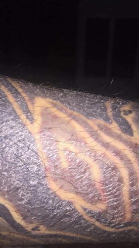 "Rợn tóc gáy" hình ảnh khách hàng bị nhiễm trùng, mưng mủ do xăm mực "dởm" - Hình 2 Rùng mình hình ảnh khách bị nhiễm trùng, mưng mủ do xăm mực “dởm“ ảnh 2