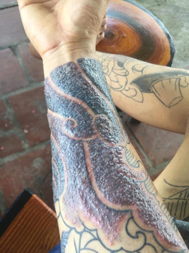 "Rợn tóc gáy" hình ảnh khách hàng bị nhiễm trùng, mưng mủ do xăm mực "dởm" Rùng mình hình ảnh khách bị nhiễm trùng, mưng mủ do xăm mực “dởm“ ảnh 1