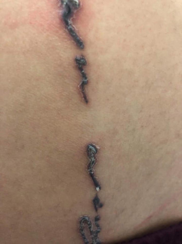 "Rợn tóc gáy" hình ảnh khách hàng bị nhiễm trùng, mưng mủ do xăm mực "dởm" - Hình 7 Rùng mình hình ảnh khách bị nhiễm trùng, mưng mủ do xăm mực “dởm“ ảnh 7