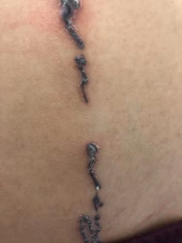 Rùng mình hình ảnh khách bị nhiễm trùng, mưng mủ do xăm mực “dởm“ ảnh 7