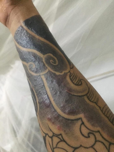 "Rợn tóc gáy" hình ảnh khách hàng bị nhiễm trùng, mưng mủ do xăm mực "dởm" - Hình 3 Rùng mình hình ảnh khách bị nhiễm trùng, mưng mủ do xăm mực “dởm“ ảnh 3