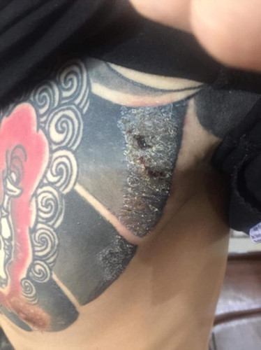 "Rợn tóc gáy" hình ảnh khách hàng bị nhiễm trùng, mưng mủ do xăm mực "dởm" - Hình 4 Rùng mình hình ảnh khách bị nhiễm trùng, mưng mủ do xăm mực “dởm“ ảnh 4