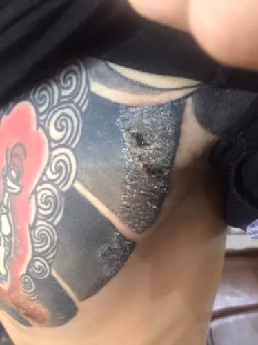 Rùng mình hình ảnh khách bị nhiễm trùng, mưng mủ do xăm mực “dởm“ ảnh 4