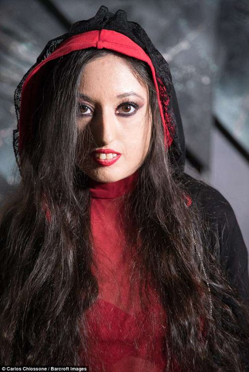 bệnh lạ,bệnh hiếm,bệnh tự miễn bệnh lạ,bệnh hiếm,bệnh tự miễn