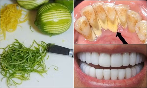 Loại bỏ cao răng triệt để sau vài phút chỉ với 1 quả chanh