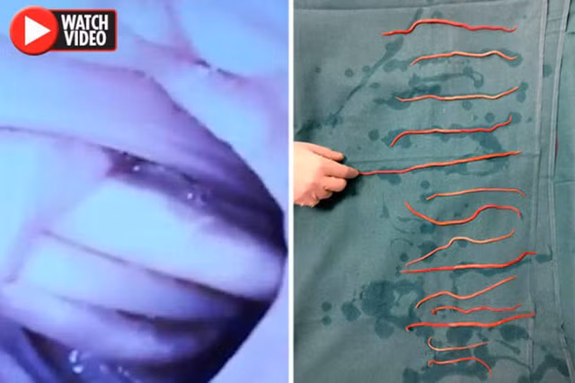 Bác sĩ bắt giun ra khỏi cơ thể bệnh nhân