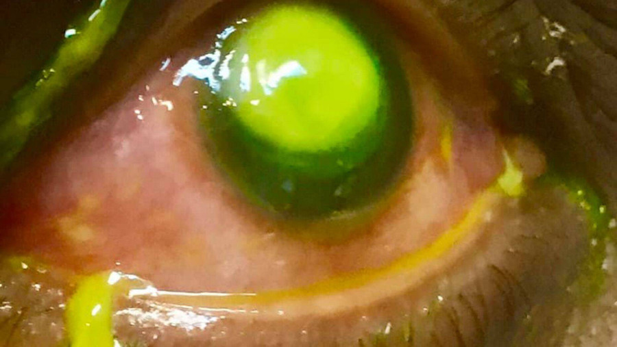 Những tổn thương do vi khuẩn gây nên có thể dẫn đến mù lòa vĩnh viễn.