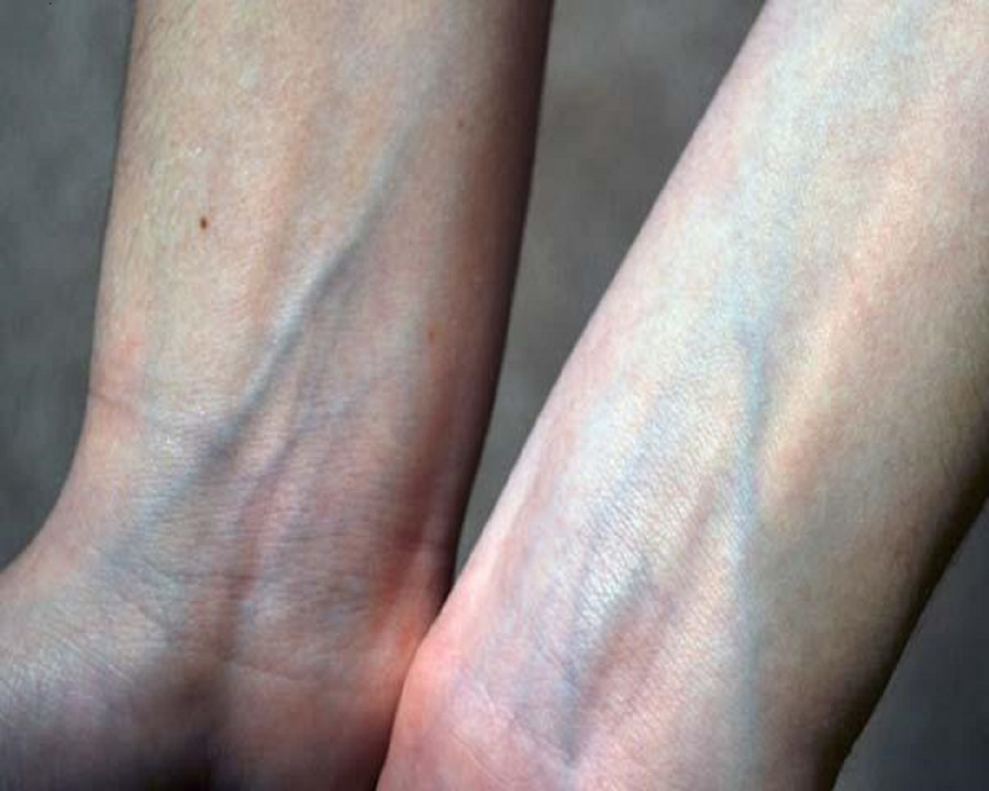 Nổi gân xanh thế này phải đi khám ngay trước khi quá muộn