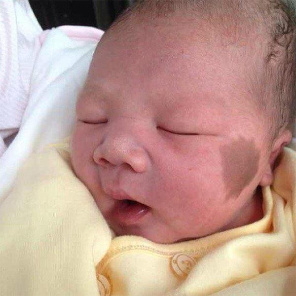 con sinh ra voi vet bot tren mat, me &#34;om dau hoi han&#34; khi bac si noi nguyen nhan - 1