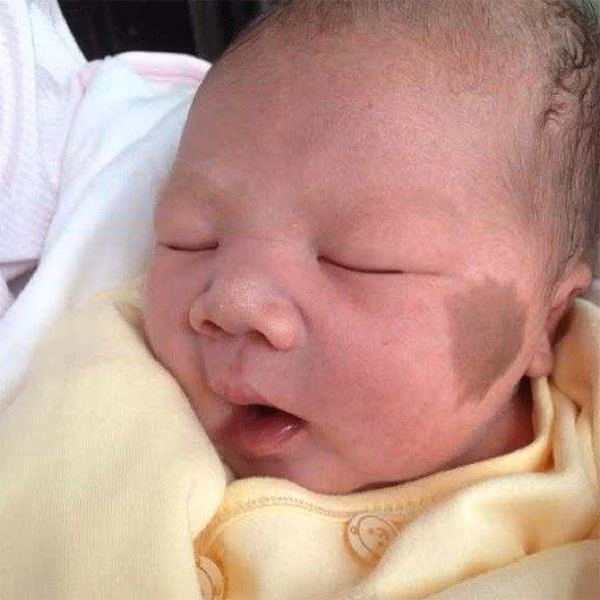 Con sinh ra có vết bớt trên mặt, mẹ “ôm đầu hối hận” khi bác sĩ nói nguyên nhân ảnh 1 con sinh ra voi vet bot tren mat, me "om dau hoi han" khi bac si noi nguyen nhan - 1