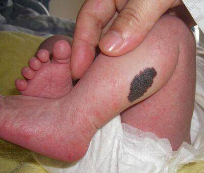 con sinh ra voi vet bot tren mat, me &#34;om dau hoi han&#34; khi bac si noi nguyen nhan - 2