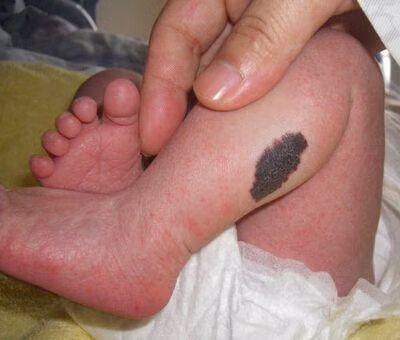 Con sinh ra có vết bớt trên mặt, mẹ “ôm đầu hối hận” khi bác sĩ nói nguyên nhân ảnh 2 con sinh ra voi vet bot tren mat, me "om dau hoi han" khi bac si noi nguyen nhan - 2