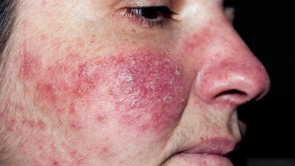 Có loại ký sinh trùng hình dáng ghê rợn sống trên mặt chúng ta hằng ngày, không phải ai cũng biết ảnh 7 thi ra loai vat co hinh dang ghe ron nay da song tren mat chung ta bay lau nay - 8