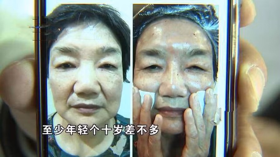 Chị Thẩm trước khi phẫu thuật thẩm mỹ.