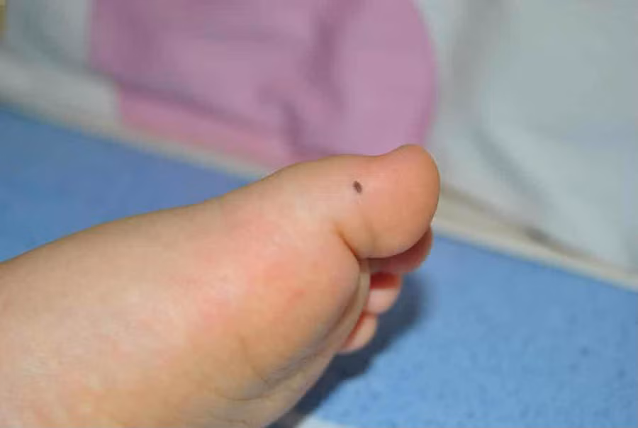 6 vị trí nốt ruồi ở bàn chân mang đến may mắn, tiền tài, địa vị cho chủ nhân ảnh 1
