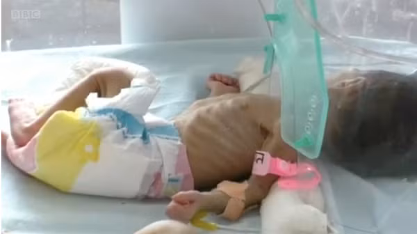 Khi vào viện, bé gái trong tình trạng hết sức nguy kịch do sinh non, cơ thể suy kiệt, nhiễm trùng, hạ thân nhiệt, hạ đường huyết