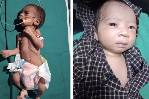 Bị chôn sâu 90cm, bé gái 1kg vẫn sống sót kỳ diệu nhờ lớp mỡ nâu trong cơ thể