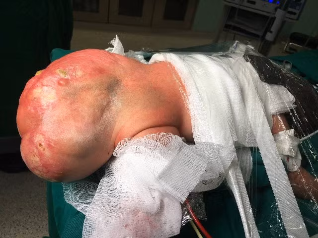 : Khối u quái khổng lồ trên người bệnh Nhi trước khi mổ