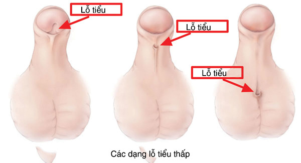 Lỗ tiểu lệch thấp là một dị tật bẩm sinh cần lưu ý