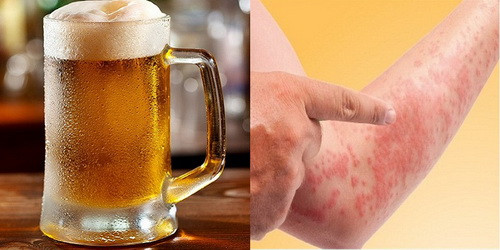Bia, rượu khiến bệnh dị ứng đa dạng, phức tạp
